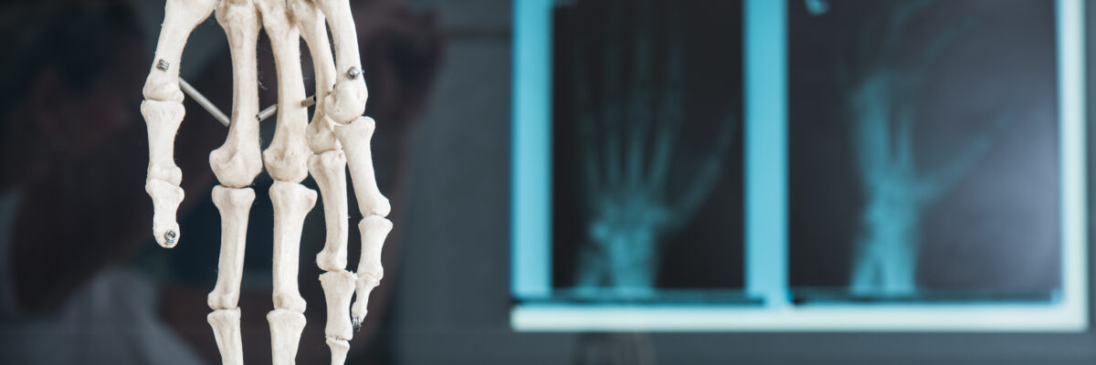 „Weißes Skelett-Hand hängt vor zwei blauen Röntgenbildern von Händen.“ Text Plastische- und Handchirurgie