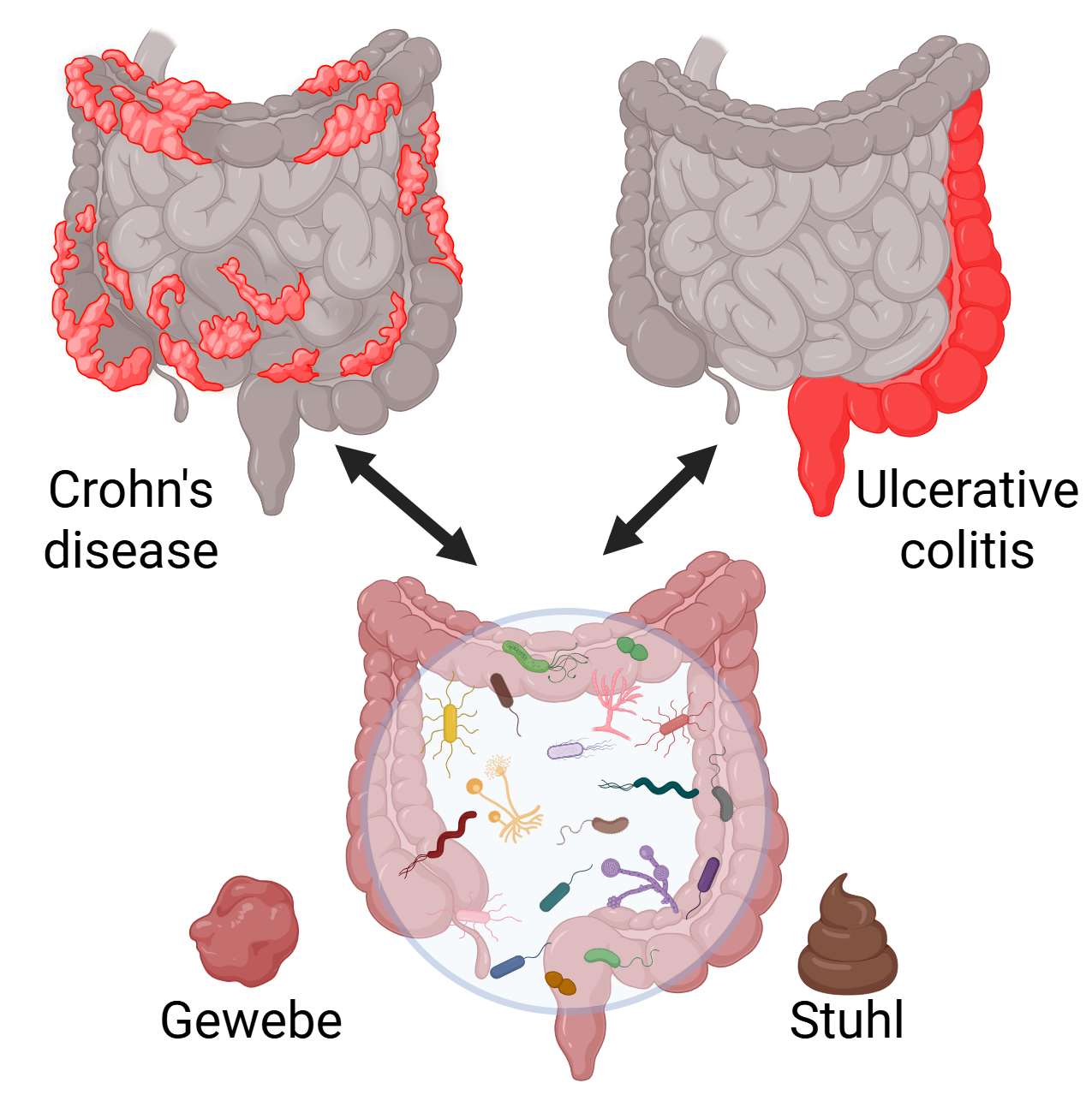 Die Grafik vergleicht die entzündeten Darmbereiche von Morbus Crohn und Colitis ulcerosa. Sie illustriert auch den Zusammenhang dieser Erkrankungen mit Darmbakterien aus Gewebe- und Stuhlproben.