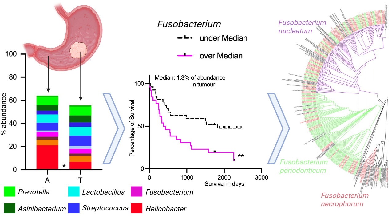 Grafik zu Fusobacterium im Magenkrebs: Bakterienverteilung im Magentumor und umgebenden Gewebe, Überlebenskurven (über/unter Median) und phylogenetischer Baum. Fusobacterium hat einen negativen Einfluss auf die Prognose von Magenkrebspatienten.